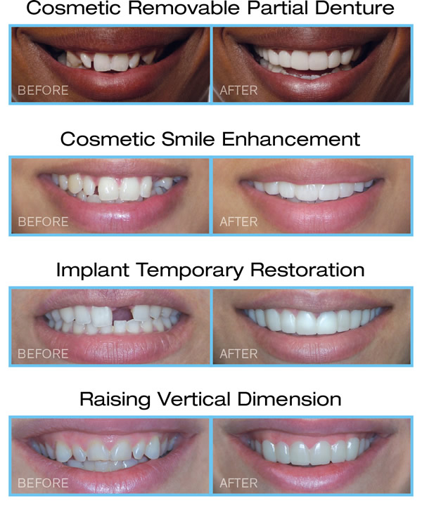 Snap on Smile ไม่ต้องจัดฟัน ไม่ต้องถอนฟัน ไม่ฉีดยา ไม่ต้องรอเป็นปี